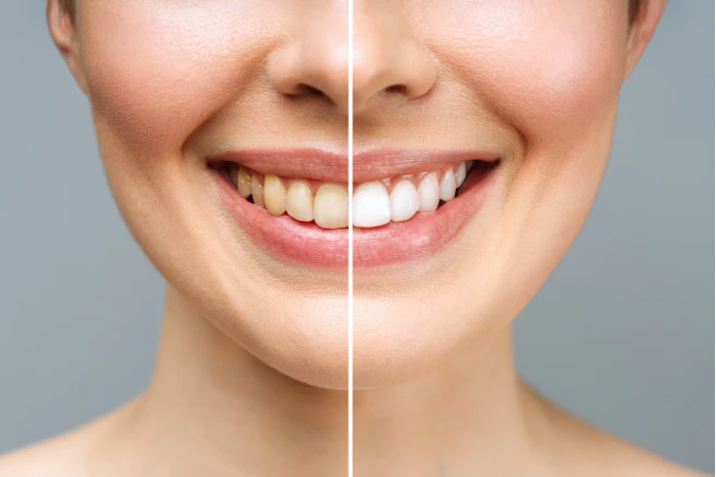 Clareamento dental Itajubá
