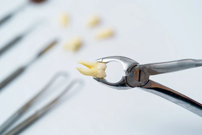 Extração Dental